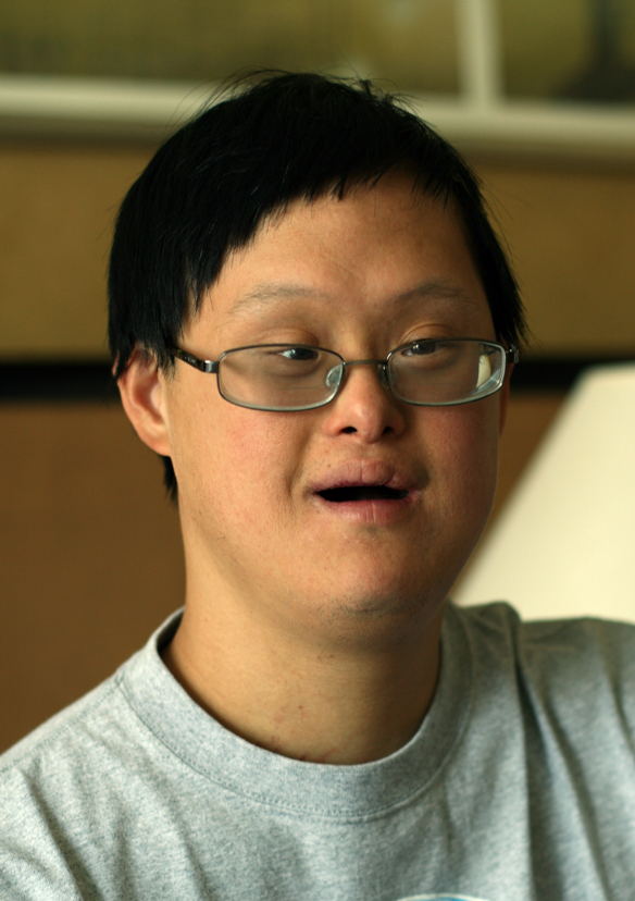 Do asian people with downs syndrome look any different 